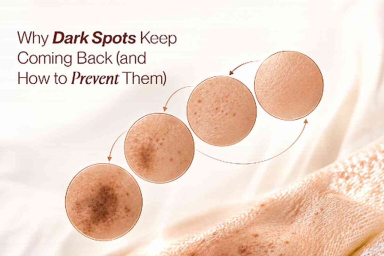 Why Dark Spots Keep Coming Back (and How to Prevent Them) Why Dark Spots Keep Coming Back and How to Prevent Them